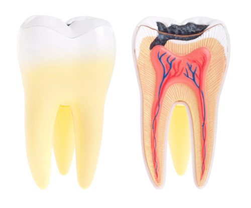 caries dentales