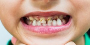 Consejos para prevenir caries y enfermedades periodontales