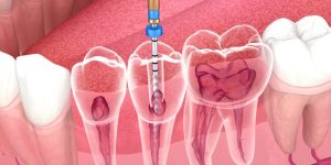 Mitos y verdades sobre la endodoncia