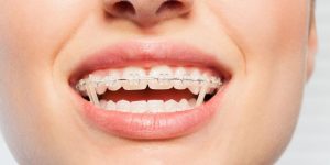 ¿Sabes por qué las gomas de ortodoncia son el secreto para una sonrisa perfecta?