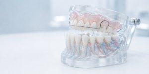 El ‘efecto rebote’ en ortodoncia: Por qué los dientes se vuelven a mover